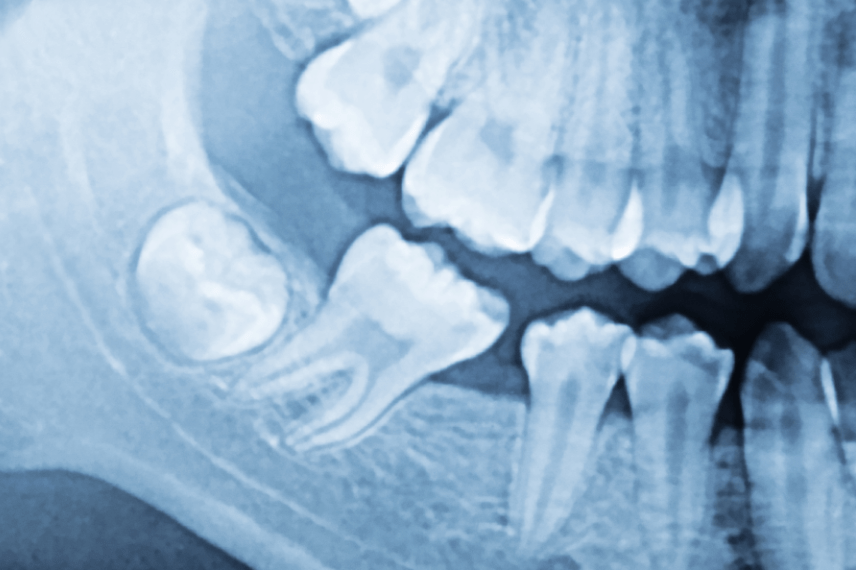 Deciduous Teeth